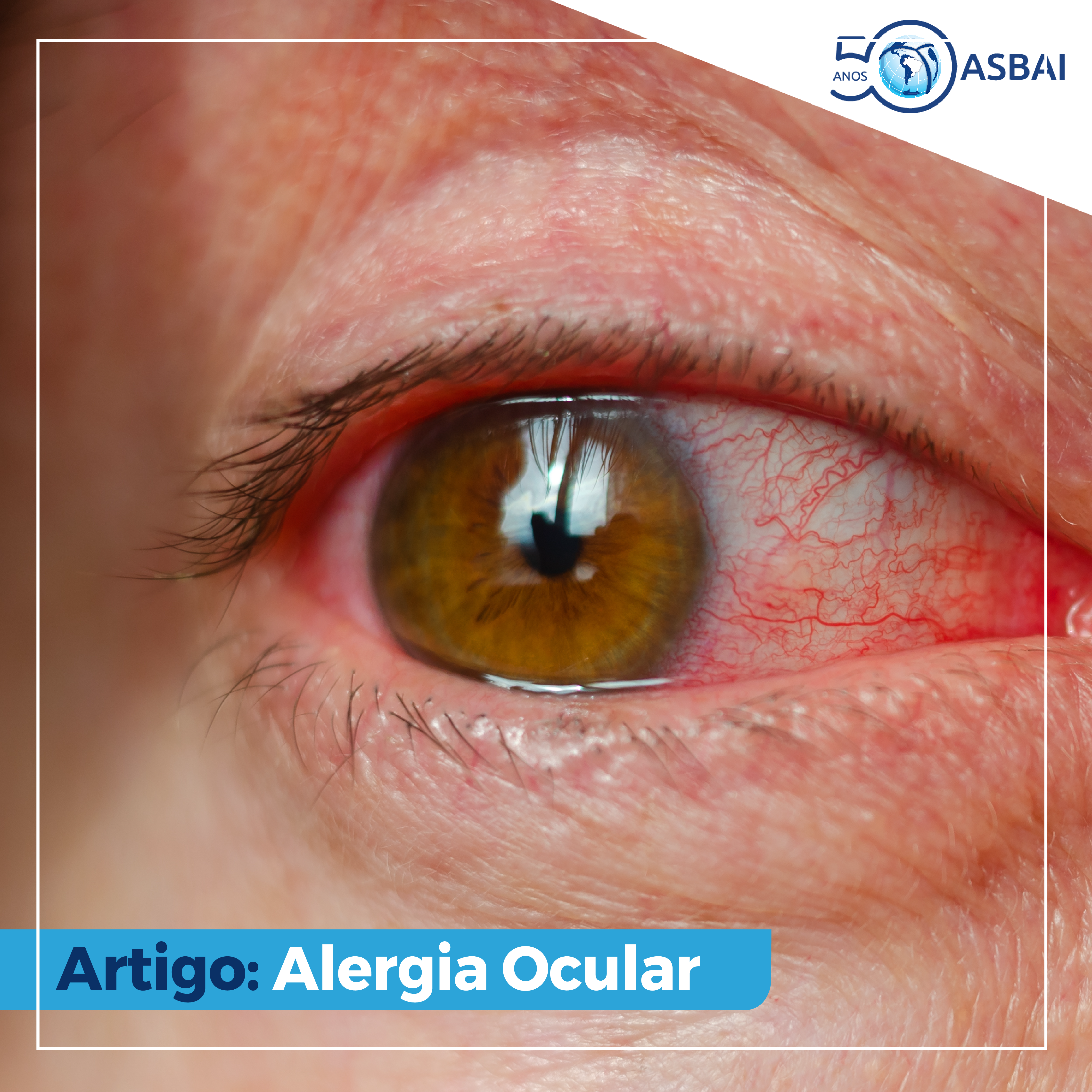 Alergia ocular pode afetar saúde mental e social do paciente